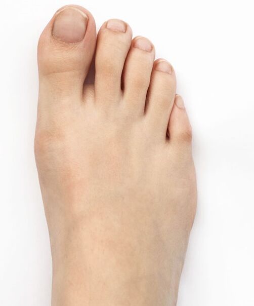 I cured my crooked thumb with Hondro Sol Valgus spray
