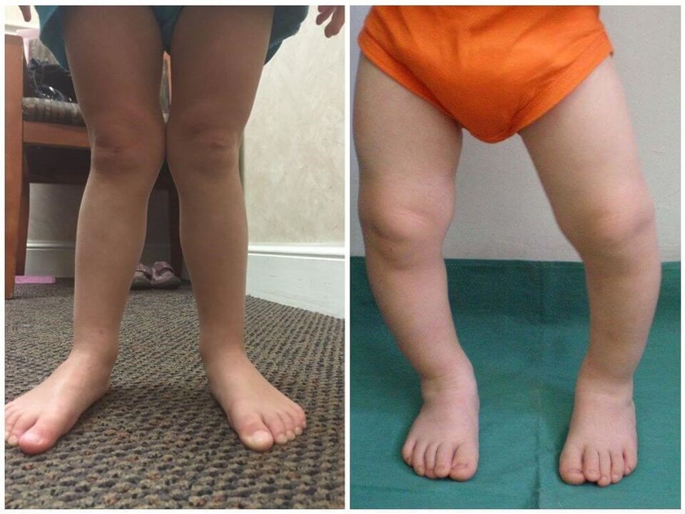 Valgus deformation in children caused