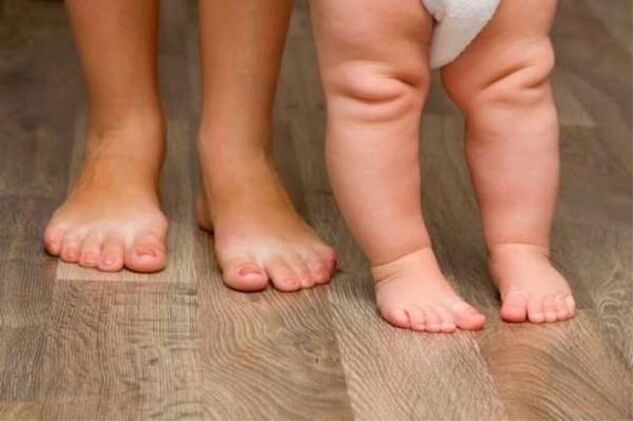 Valgus deformation