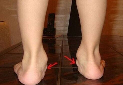Deforming Valgus of the foot in children