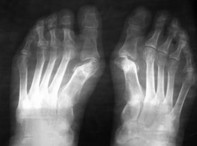 Indicate activities under Valgus of the foot