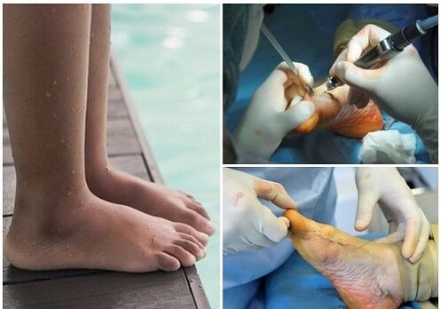 Small invasive surgery treatment