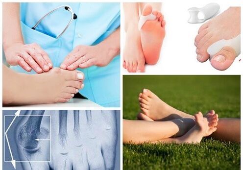 Valgus deformation treatment