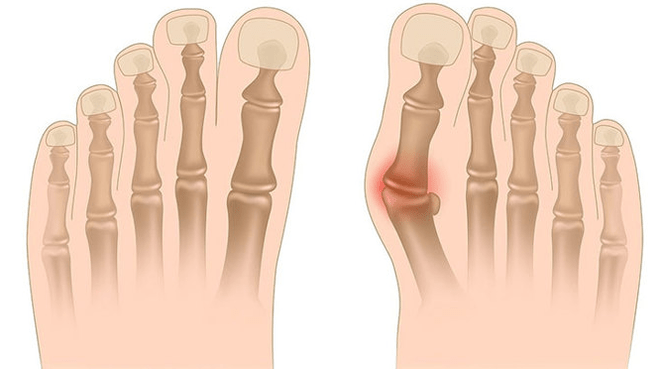 Valgus deformation treatment