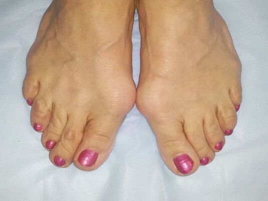 Hallux valgus deformity of the foot