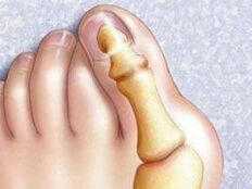 Hallux valgus deformity