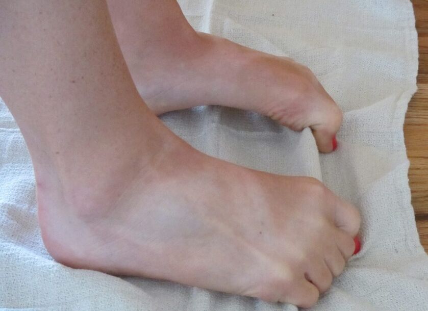 Exercises for feet with deformed big toes